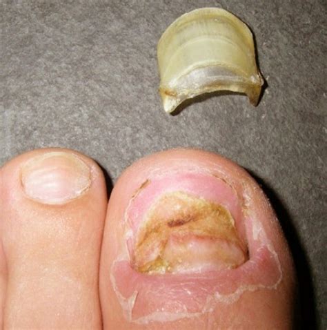 👉 Toenail Falling Off Symptoms Causes And Treatment December 2021