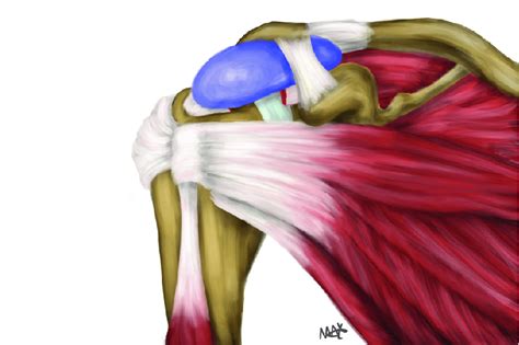 Schematic Diagram Of Inspace Balloon Inserted In The Subacromial Space