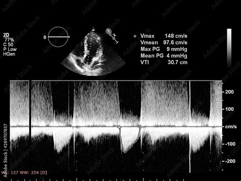 Screen of echocardiography (ultrasound) machine. Stock Photo | Adobe Stock