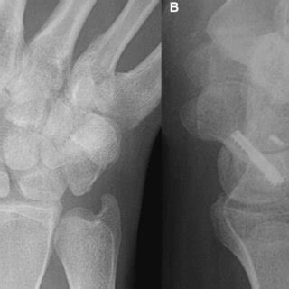 Anteroposterior A And Lateral B Radiographs Of The Right Wrist