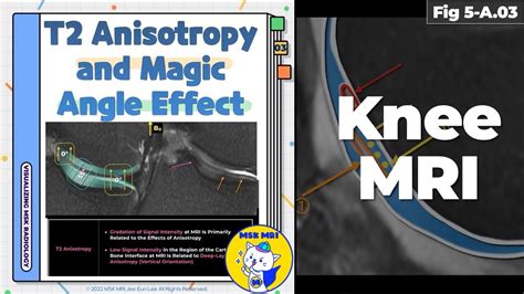 Fig 5 A 03 T2 Anisotropy And Magic Angle Effect Youtube