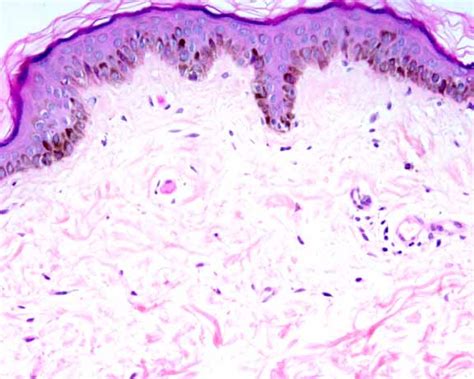 Telangiectasia Macularis Eruptiva Perstans Histology