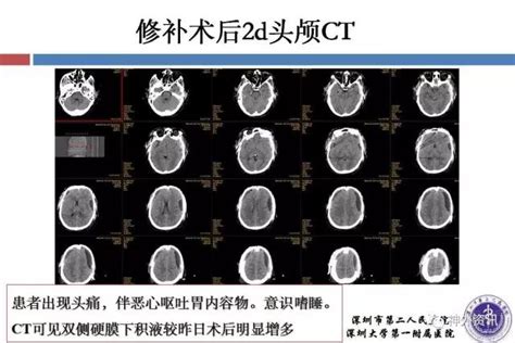 颅脑创伤 神经重症病例周刊（第8期） 双侧额颞顶去骨瓣减压术后双侧硬膜下积液一例 脑医汇 神外资讯 神介资讯