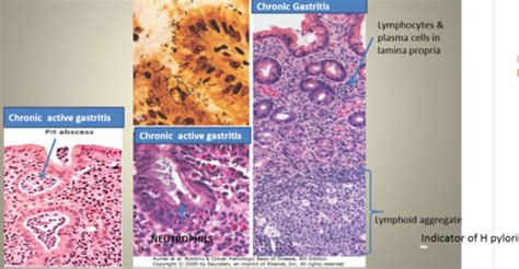 Peptic Ulcer Disease And Gastritis Flashcards Quizlet