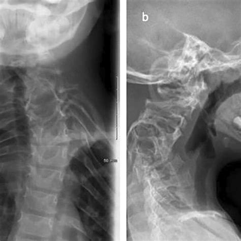 Case 1 Anterior Posterior A And Lateral B Radiographs Of The Download Scientific Diagram