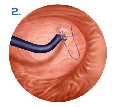 Gastroplastie Endoscopique Sans Cicatrices Endo Sleeve Aix En Provence