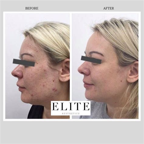 Hydrafacial Before and After Photos for Elite Aesthetics Clients in ...