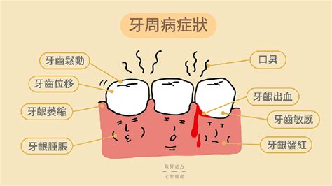 牙周病8大常見症狀，牙醫師建議的刷牙方式與治療介紹