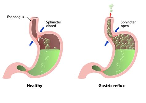 Acid Reflux — High Plains Surgical Associates