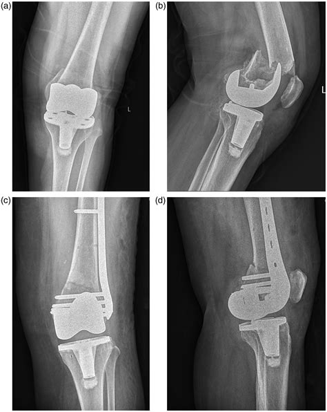 Comparison Of Locking Compression Plate And Distal Femoral Replacement For Periprosthetic Distal