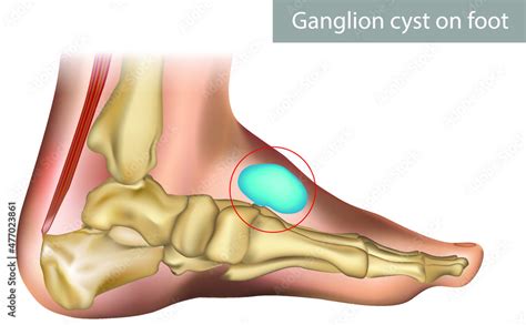 Vecteur Stock Medical Vector Illustration Of Ganglion Foot Cyst With Hot Sex Picture