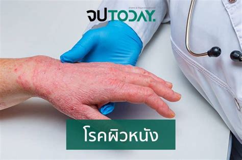 โรคจากการประกอบอาชีพ Occupational Disease สำหรับ จป วิชาชีพ