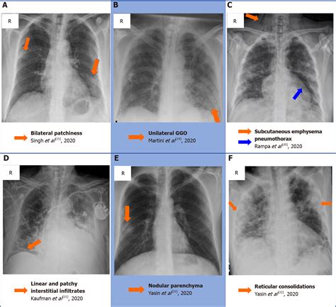 Chest X Ray Consolidation Vs Infiltrate