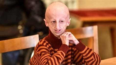 Addio A Sammy Basso Il Pi Longevo Malato Di Progeria