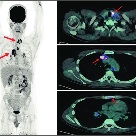 Positron emission tomography-computed tomography imaging. Coronal and ... 