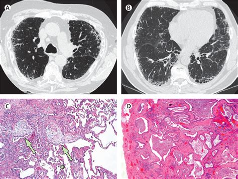 Idiopathic Pulmonary Fibrosis The Lancet