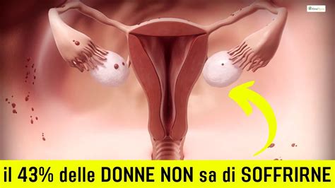 Ecco Cosa FUNZIONA Per Chi Soffre Di VULVODINIA Ed ENDOMETRIOSI YouTube