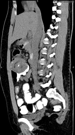 Colocolic Intussusception Due To Mucinous Carcinoma Of The Colon