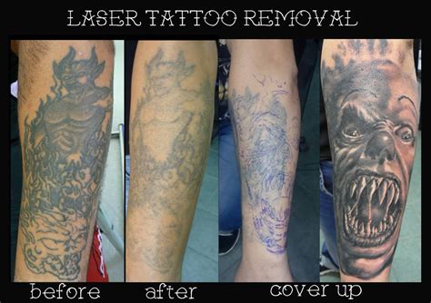 Лазерно премахване на татуировки | Inside Ink Tattoo Studio