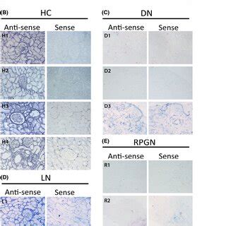 LINC01187 LncRNA Expression Is Downregulated In Renal Tissue From