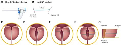 Urolift System Components And Procedure The Urolift System Is Comprised