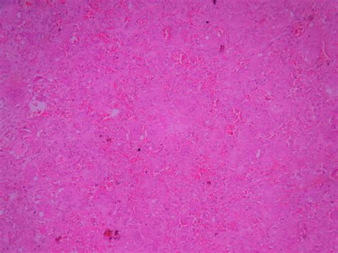 Osteoclastoma – Histopathology.guru