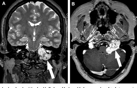 Figure From Jugular Foramen Schwannoma Mimicking Paraganglioma Case