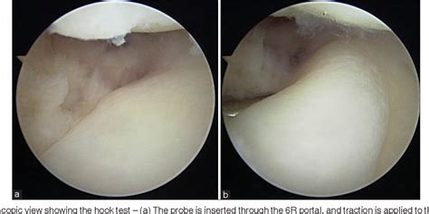 Figure 1 From Arthroscopic Assisted Repair Of Triangular Fibrocartilage