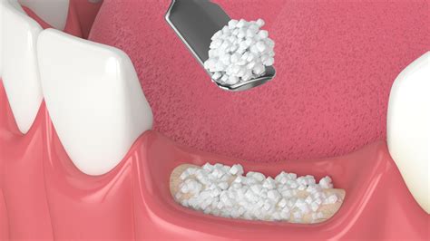 Alternatives to Dental Implants: A Comparison of Costs, Pros and Cons