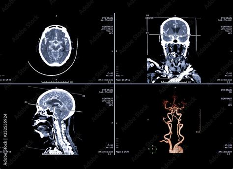 Fotka Computed Tomography Angiography Or CTA Brain 3D Rendering Image