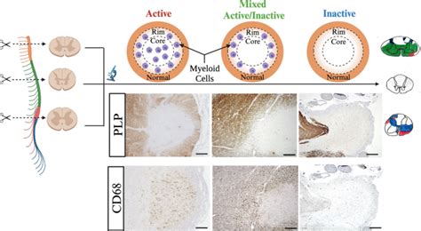 The Prevalence And Topography Of Spinal Cord Demyelination In Multiple