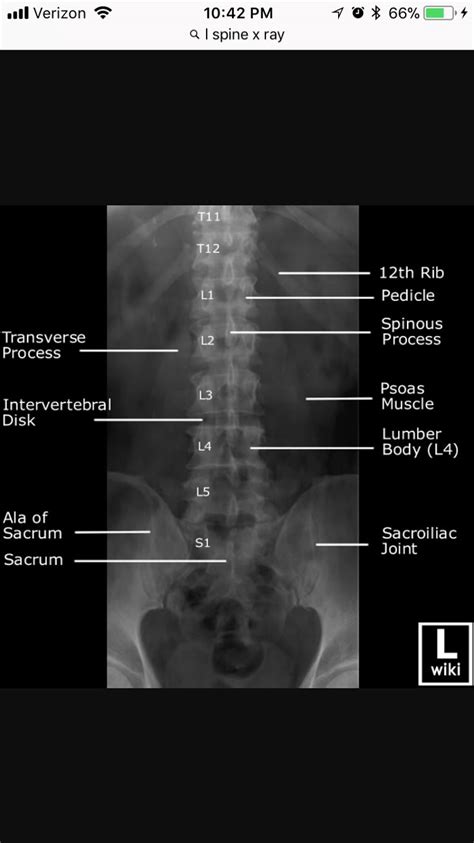 Lumbar Vertebrae X Ray