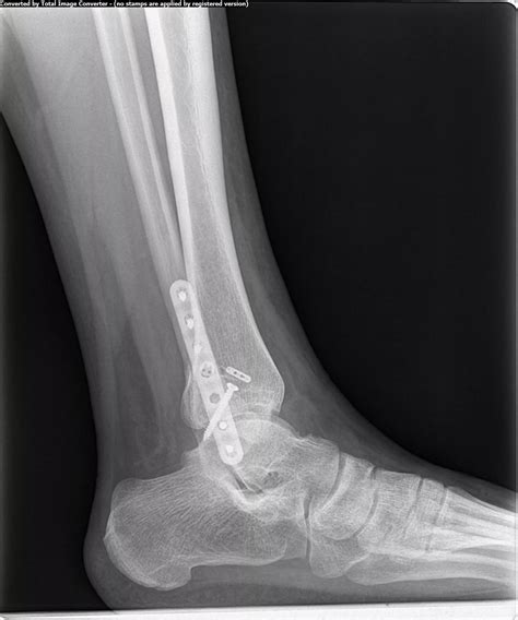 Ankle Fracture Types