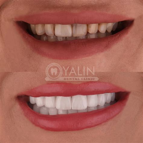 E Max Laminate Veneers In Turkey Antalya