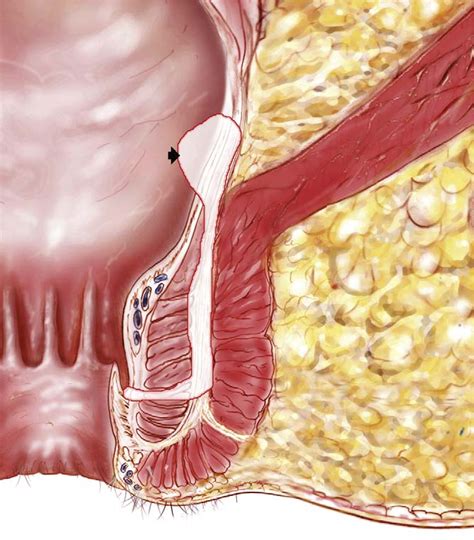 Table From Cryptoglandular Anal Fistula Semantic Scholar