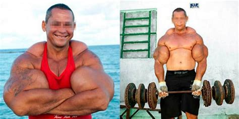 Synthol O Que é Por Que Muitos Usam Como Funciona E Riscos