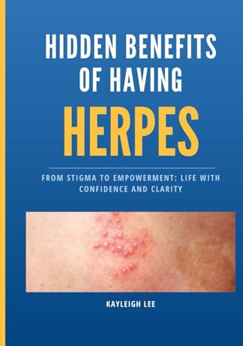 Hidden Benefits Of Having Herpes Living With Herpes From Stigma To