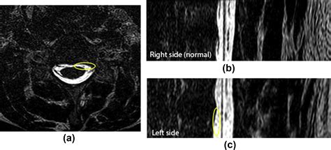 Axial T2 DRIVE MRI Myelography Is Highly Accurate In Diagnosing