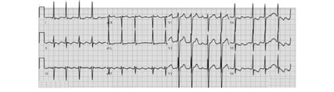 Twelve Lead Electrocardiogram In Atrial Flutter With Variable Av Block