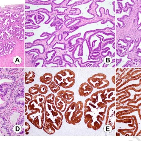 A Histological Findings Of The Endocervical Lesion Endocervical