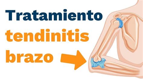 Cómo tratar la TENDINITIS EN EL BRAZO YouTube