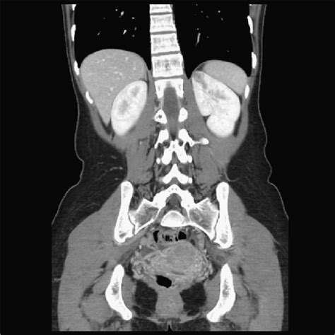 Abdominal Computed Tomography Shows A Well Defined 15 Cm Mass In The Download Scientific