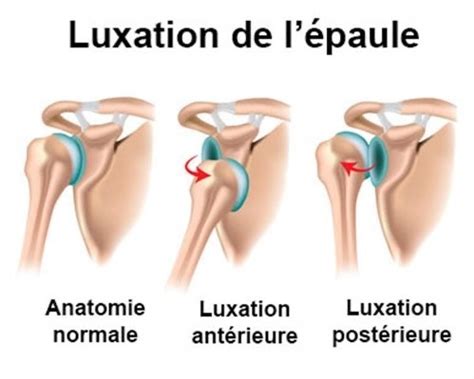 Item 361 2 Lésions péri articulaires et ligamentaires de l épaule