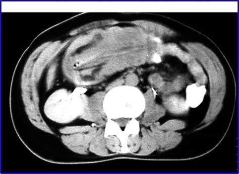 Colocolic Intussusception Radrounds Radiology Network