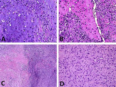 Pleomorphic Dermal Sarcoma With Osteosarcoma Like And Chondrosarcoma