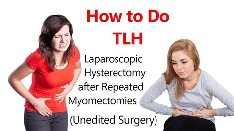 Laparoscopic Hysterectomy Tlh After Repeated Myomectomies Unedited