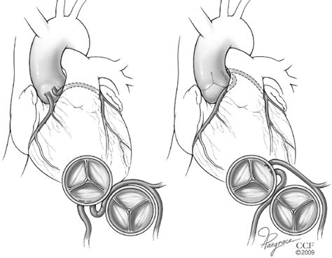 Long Term Outcome And Impact Of Surgery On Adults With Coronary