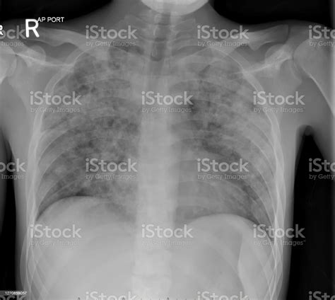 Radiografía Del Tórax En Un Paciente Con Tuberculosis Pulmonar Activa