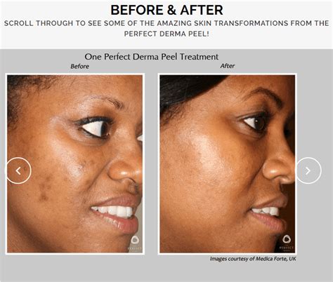 Chemical Peels Dermatology Care Of Charlotte