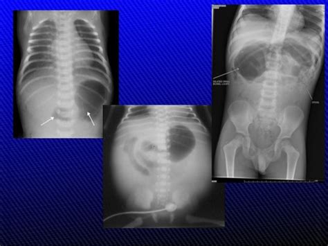 radiology  malrotation
